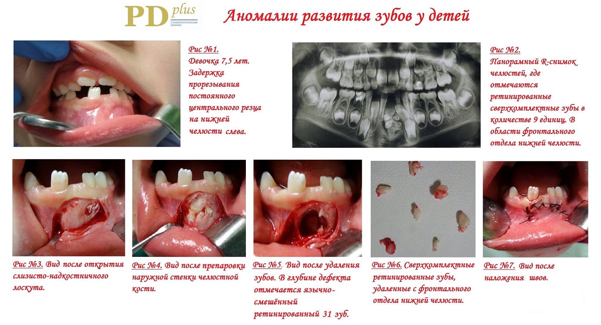 Перелом челюсти при удалении зуба мудрости | TopDent | Дзен