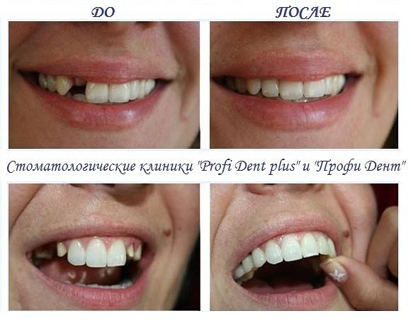 Реставрация зубов в Москве: цены на услуги, виды и способы реставрации, фото работ до и после.